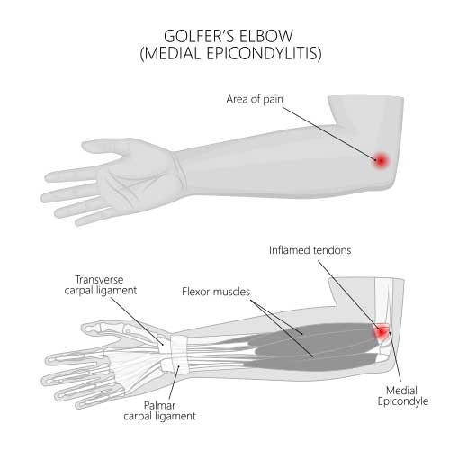 Golfer's Elbow
